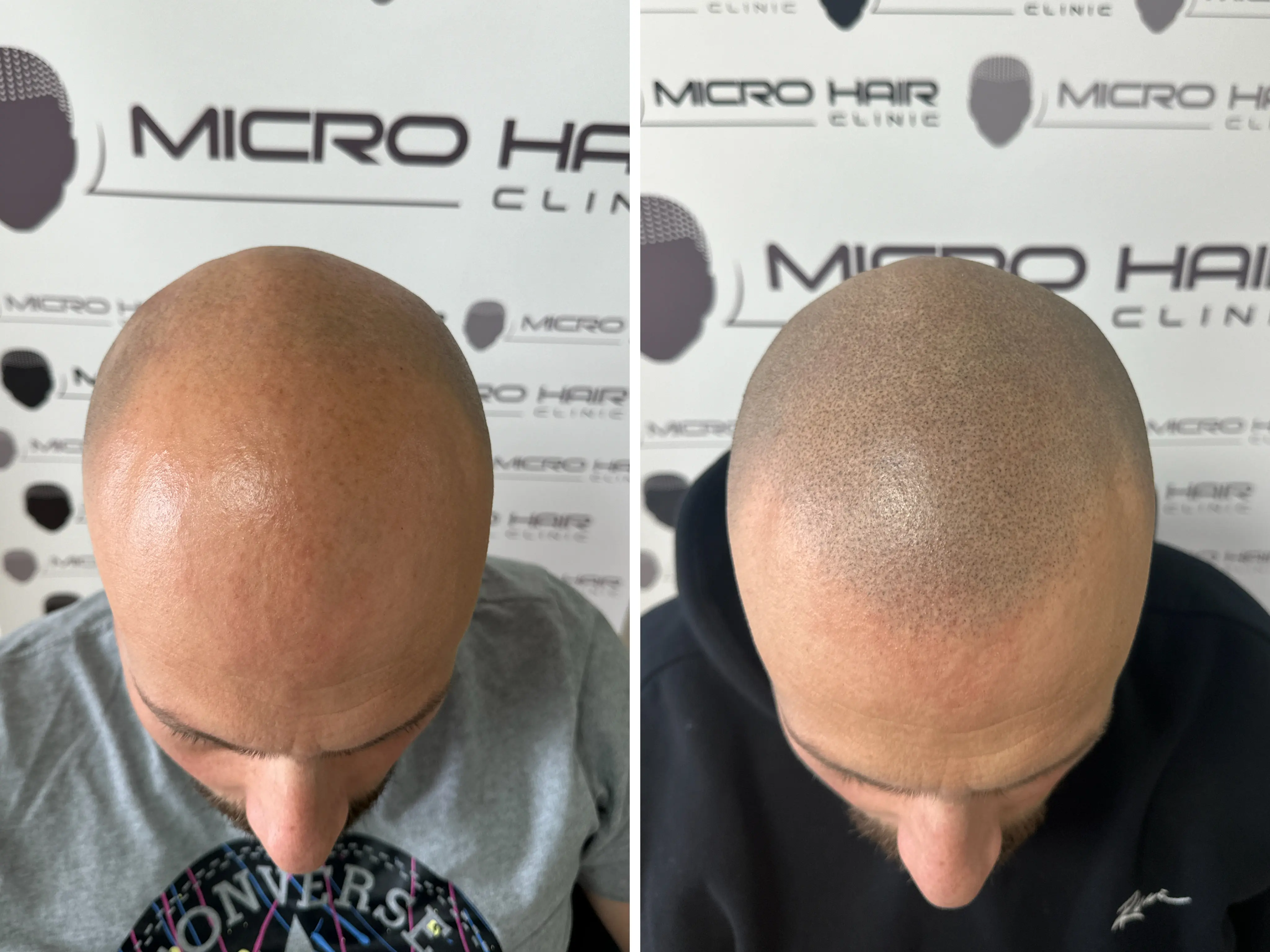 SMP rezultat pred in po - tretman mikropigmentacije 5